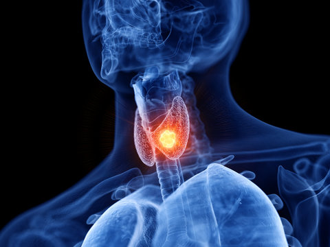 Thyroid Disorders