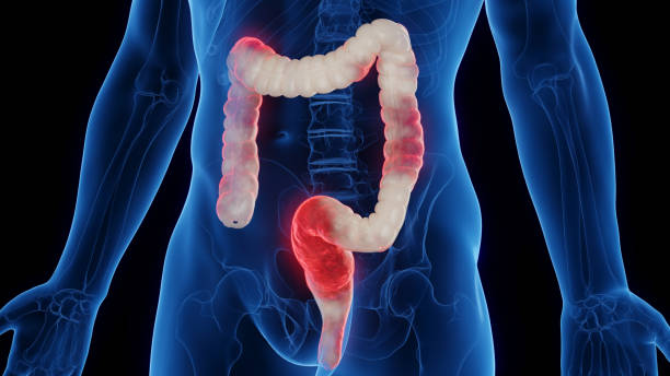 Surgery for Inflammatory Bowel Disease