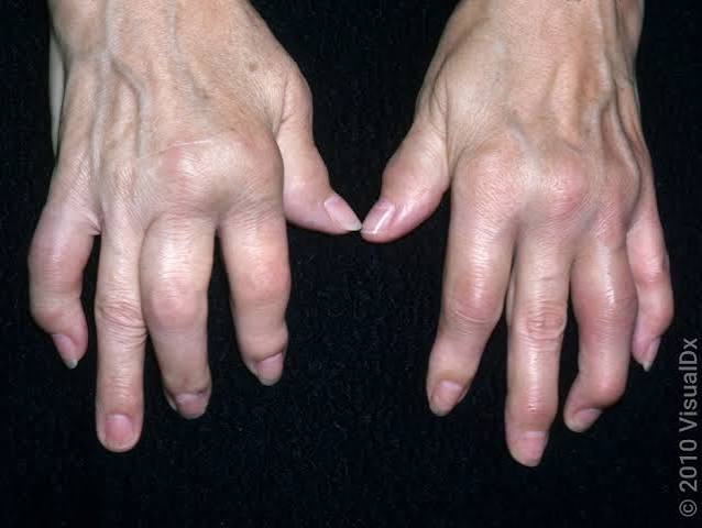 Rheumatoid Arthritis, Psoriatic Arthritis