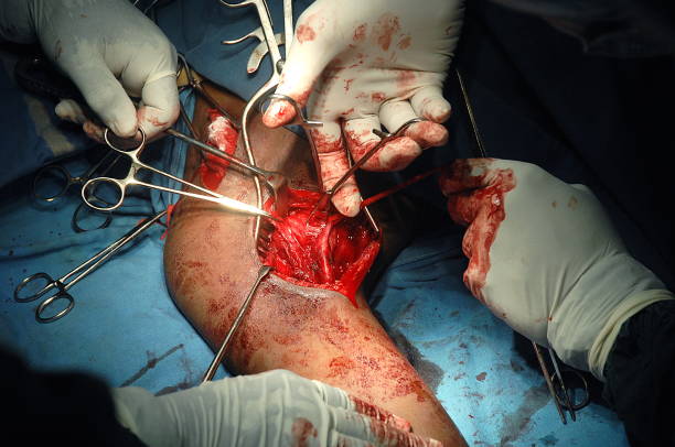 Aneurysm Repair