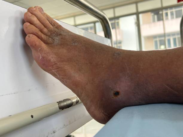 Diabetic Foot Care
