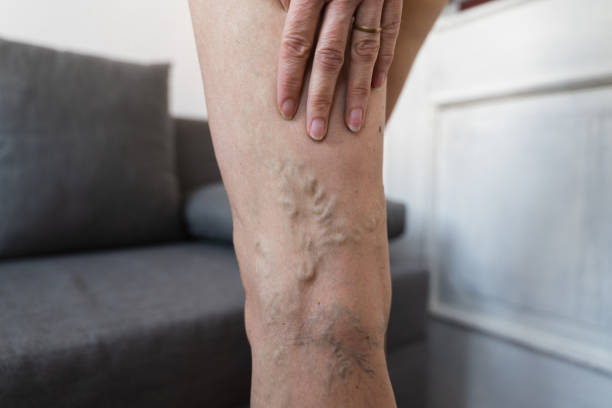 Varicose Vein Treatment
